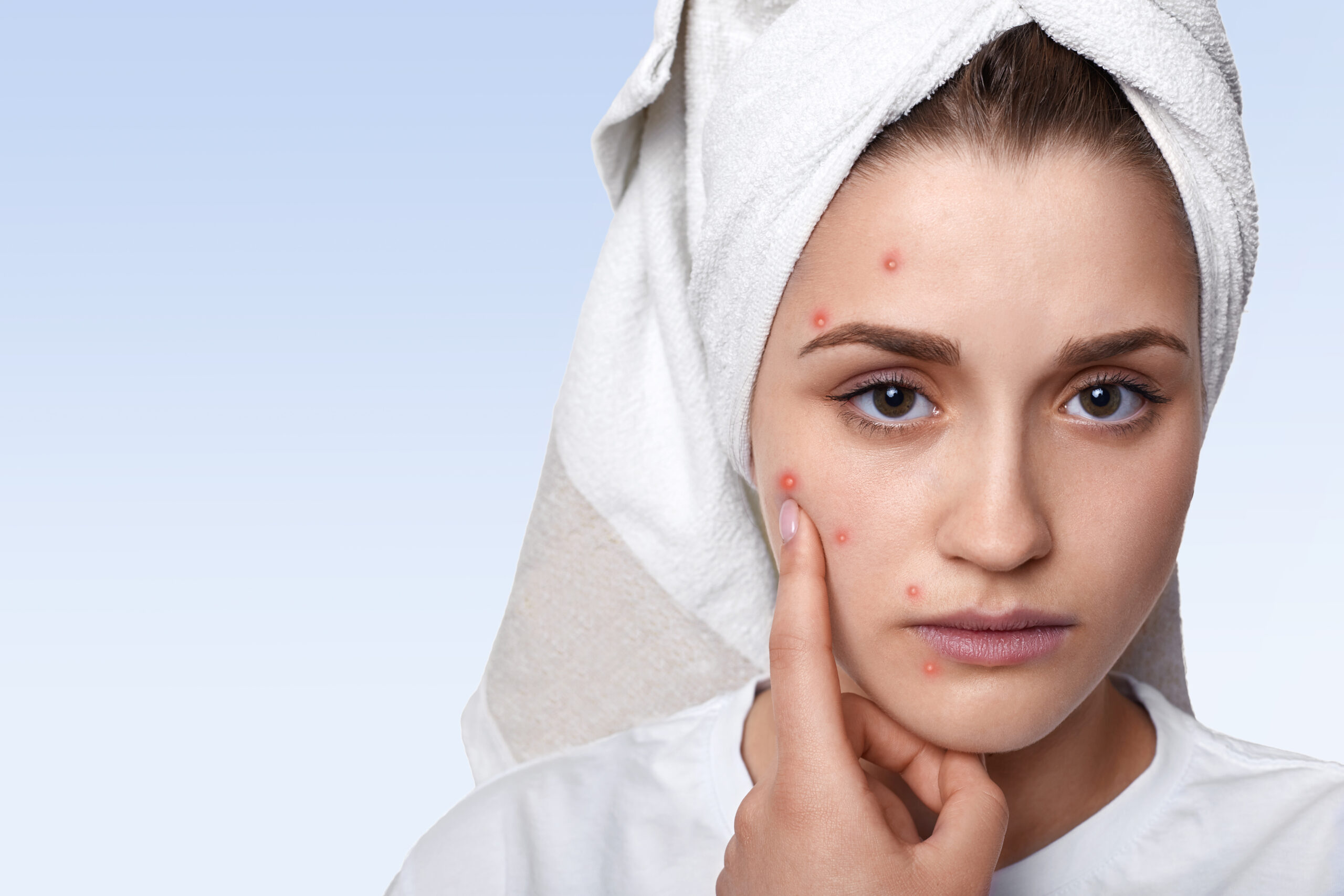 An isolated portrait of young woman having problem skin and pimple on her cheek, wearing towel on her head having sad expression pointing at her pimple being in bathroom. Beauty and spa concept.