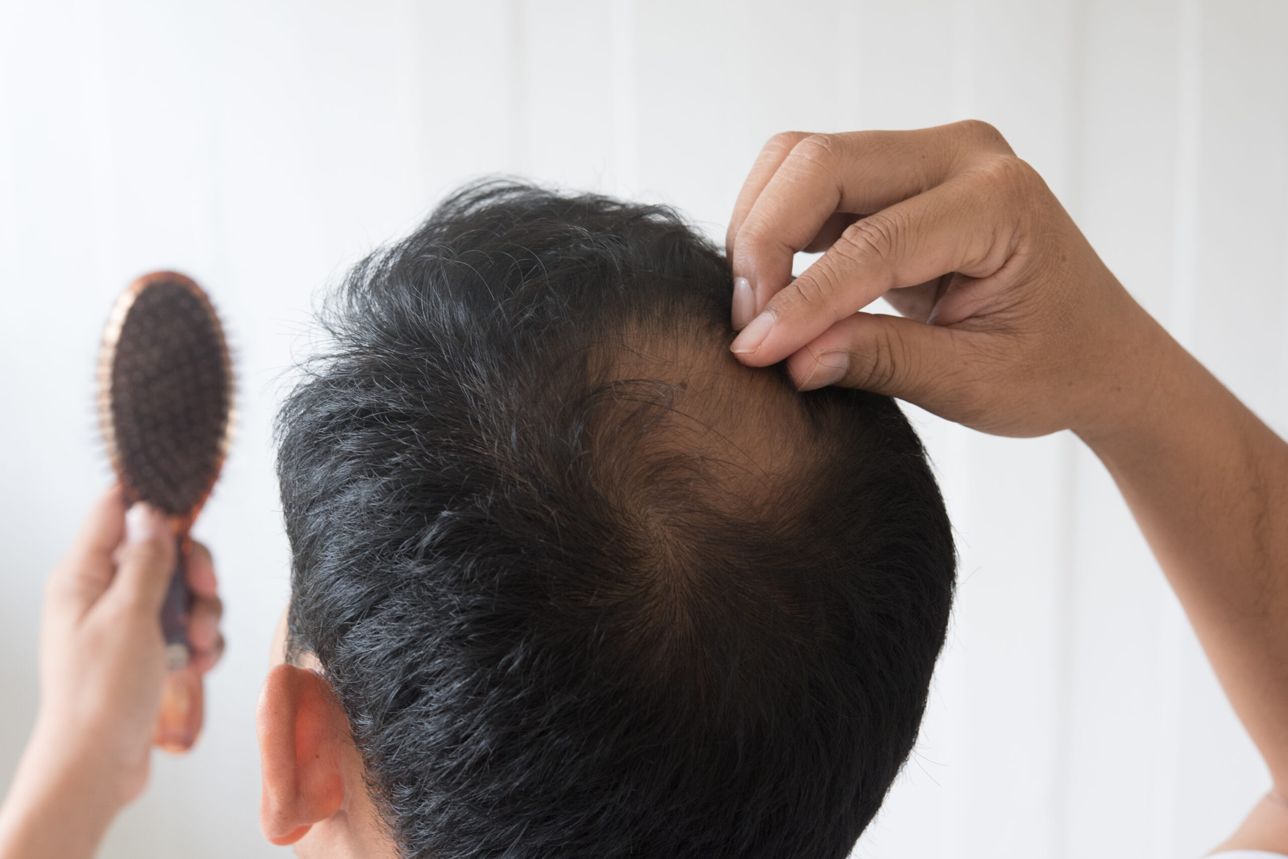 Men are worried about hair loss.