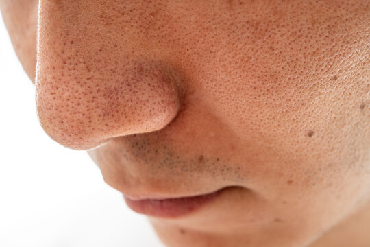 Blackhead Removal